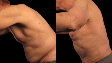 Tummy Tuck in Dubai