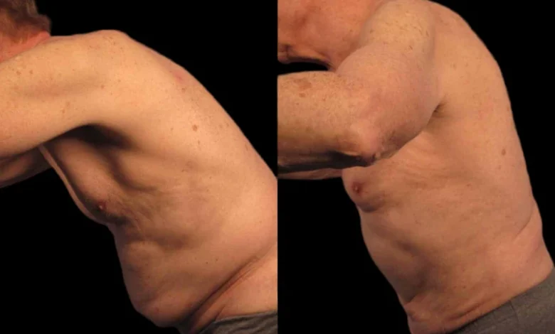 Tummy Tuck in Dubai
